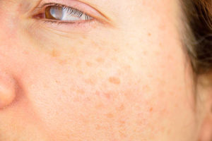 Sunspots, Skin Discoloration, and Hyperpigmentation