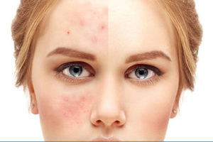 Acne & Rosacea